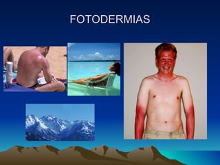 FOTODERMIAS 