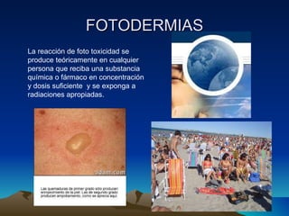 FOTODERMIAS La reacción de foto toxicidad se produce teóricamente en cualquier persona que reciba una substancia química o fármaco en concentración y dosis suficiente  y se exponga a radiaciones apropiadas. 