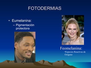 FOTODERMIAS   Eumelanina:  Pigmentaci ón protectora Feomelanina: Especies Reactivas de Ox í geno 