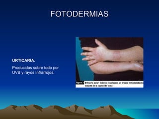 FOTODERMIAS URTICARIA.  Producidas sobre todo por UVB y rayos Infrarrojos. 