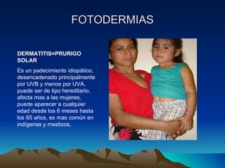 FOTODERMIAS DERMATITIS=PRURIGO SOLAR  Es un padecimiento idiopático, desencadenado principalmente por UVB y menos por UVA, puede ser de tipo hereditario, afecta mas a las mujeres, puede aparecer a cualquier edad desde los 6 meses hasta los 65 años, es mas común en indígenas y mestizos, 