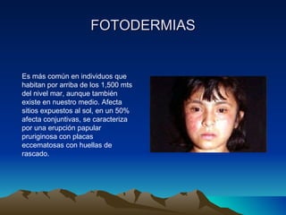 FOTODERMIAS Es más común en individuos que habitan por arriba de los 1,500 mts del nivel mar, aunque también existe en nuestro medio. Afecta sitios expuestos al sol, en un 50% afecta conjuntivas, se caracteriza por una erupción papular pruriginosa con placas eccematosas con huellas de rascado. 