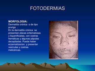FOTODERMIAS MORFOLOGIA: Dermatitis crónica  o de tipo prurigo  . En la dermatitis crónica  se presentan placas eritematosas y liquenificadas, con costras hemáticas y algunas pápulas decapitadas. Puede haber  eczematizacion  y presentar vesículas y costras melicéricas. 