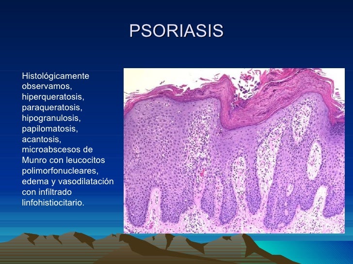 En que el peligro de la psoriasis