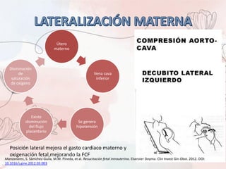 Útero
materno
Vena cava
inferior
Se genera
hipotensión
Existe
disminución
del flujo
placentario
Disminución
de
saturación
de oxígeno
Posición lateral mejora el gasto cardíaco materno y
oxigenación fetal,mejorando la FCF
Manzanares, S. Sámchez-Guila, M.M. Pineda, et al. Resucitación fetal intrauterina. Elservier Doyma. Clin Invest Gin Obst. 2012. DOI:
10.1016/j.gine.2012.03.003
 