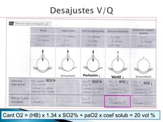 16
Cant O2 = (HB) x 1.34 x SO2% + paO2 x coef solub = 20 vol %
Perfusión ↓
Ventil ↓
SO2 N SO2 N SO2 ↓ SO2 ↓
 