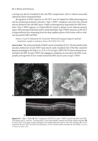 82 ● Retina and Vitreous
scarring may also be visualized in the sub-­
PED compartment, with or without associated
subret­i­nal and/or intraret­i­nal fluid.
Recognition of MNV patterns on SD-­
OCT may be helpful for differential diagnosis
and for predicting treatment outcomes. Type 1 MNV complexes start from the choroid
and are ­
limited to the sub-­
RPE space, vis­
i­
ble as heterogeneous hyperreflective RPE eleva-
tions. Type 2 MNV appears as a hyperreflective band or plaque in the subneurosensory
space, with associated subret­
i­
nal and/or intraret­
i­
nal fluid. Type 3 MNV pre­
sents on SD-­
OCT
as hyperreflective foci emanating from the deep capillary plexus of the ret­
ina, with or with-
out associated CME and PED.
Mrejen S, Sarraf D, Mukkamala SK, Freund KB. Multimodal imaging of pigment epithelial
detachment: a guide to evaluation. Ret­i­na. 2013;33(9):1735–1762.
octa of mnv ​
The structural details of MNV can be revealed by OCTA. The fine details of the
vascular architecture of each MNV type may be easily visualized, ­
free of the blur caused by
fluorescein leakage in FA (Figs 4-11, 4-12, 4-13). In type 1 MNV, OCTA shows abnormal ves-
sels below the RPE. In type 2 MNV, the angiogenic complexes are seen above the RPE. Com-
parably, downgrowth of new vessels ­
toward the RPE may be seen in type 3 MNV.
C
A B
Figure 4-11 Type 1 MNV. A, OCT angiogram (OCTA) of type 1 MNV located beneath the RPE.
The lesion has a “sea fan” configuration, with large feeder vessels and large caliper vessels. B,
En face OCT structural image highlights the hyperreflective dome over the vessels. C, Cross-­
sectional B-­
scan OCT shows the distortion of the ret­
i­
nal profile caused by the MNV. (Courtesy
of Richard B. Rosen, MD.)
 