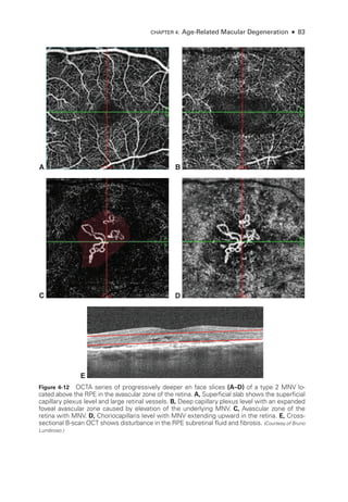 Chapter 4: Age-­
Related Macular Degeneration ● 83
E
A B
C D
Figure 4-12 OCTA series of progressively deeper en face slices (A–­D) of a type 2 MNV lo-
cated above the RPE in the avascular zone of the ret­
ina. A, Superficial slab shows the superficial
capillary plexus level and large ret­
i­
nal vessels. B, Deep capillary plexus level with an expanded
foveal avascular zone caused by elevation of the under­
lying MNV. C, Avascular zone of the
ret­
ina with MNV. D, Choriocapillaris level with MNV extending upward in the ret­
ina. E, Cross-­
sectional B-­
scan OCT shows disturbance in the RPE subret­
i­
nal fluid and fibrosis. (Courtesy of Bruno
Lumbroso.)
 