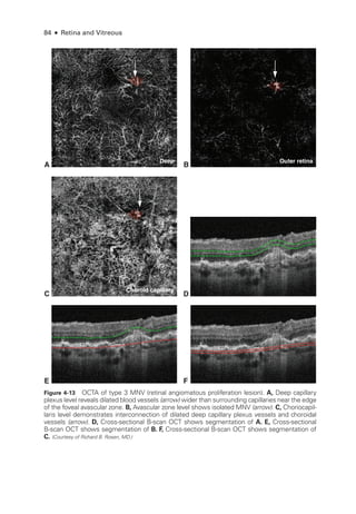 84 ● Retina and Vitreous
Choroid capillary
A B
C D
E F
Deep Outer retina
Figure 4-13 OCTA of type 3 MNV (ret­
i­
nal angiomatous proliferation lesion). A, Deep capillary
plexus level reveals dilated blood vessels (arrow) wider than surrounding capillaries near the edge
of the foveal avascular zone. B, Avascular zone level shows isolated MNV (arrow). C, Choriocapil-
laris level demonstrates interconnection of dilated deep capillary plexus vessels and choroidal
vessels (arrow). D, Cross-­
sectional B-­
scan OCT shows segmentation of A. E, Cross-­sectional
B-­
scan OCT shows segmentation of B. F, Cross-­
sectional B-­
scan OCT shows segmentation of
C. (Courtesy of Richard B. Rosen, MD.)
 