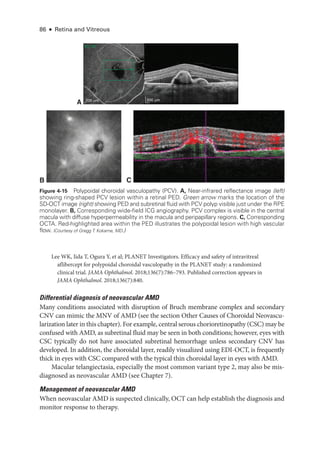 86 ● Retina and Vitreous
Lee WK, Iida T, Ogura Y, et al; PLANET Investigators. Efficacy and safety of intravitreal
aflibercept for polypoidal choroidal vasculopathy in the PLANET study: a randomized
clinical trial. JAMA Ophthalmol. 2018;136(7):786–793. Published correction appears in
JAMA Ophthalmol. 2018;136(7):840.
Differential diagnosis of neovascular AMD
Many conditions associated with disruption of Bruch membrane complex and secondary
CNV can mimic the MNV of AMD (see the section Other ­
Causes of Choroidal Neovascu-
larization ­later in this chapter). For example, central serous chorioretinopathy (CSC) may be
confused with AMD, as subret­
i­
nal fluid may be seen in both conditions; however, eyes with
CSC typically do not have associated subret­
i­
nal hemorrhage ­
unless secondary CNV has
developed. In addition, the choroidal layer, readily visualized using EDI-­
OCT, is frequently
thick in eyes with CSC compared with the typical thin choroidal layer in eyes with AMD.
Macular telangiectasia, especially the most common variant type 2, may also be mis-
diagnosed as neovascular AMD (see Chapter 7).
Management of neovascular AMD
When neovascular AMD is suspected clinically, OCT can help establish the diagnosis and
monitor response to therapy.
B C
A 200 μm
200 μm
53 / 97
Figure 4-15 Polypoidal choroidal vasculopathy (PCV). A, Near-­
infrared reflectance image (left)
showing ring-­
shaped PCV lesion within a ret­
i­
nal PED. Green arrow marks the location of the
­SD-­OCT image (right) showing PED and subret­
i­
nal fluid with PCV polyp vis­
i­
ble just ­
under the RPE
monolayer. B, Corresponding wide-­
field ICG angiography. PCV complex is vis­
i­
ble in the central
macula with diffuse hyperpermeability in the macula and peripapillary regions. C, Corresponding
OCTA. Red-­
highlighted area within the PED illustrates the polypoidal lesion with high vascular
flow. (Courtesy of Gregg T. Kokame, MD.)
 