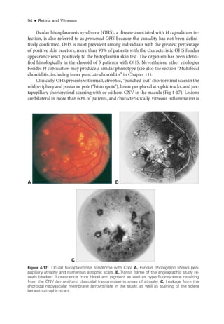 94 ● Retina and Vitreous
Ocular histoplasmosis syndrome (OHS), a disease associated with H capsulatum in-
fection, is also referred to as presumed OHS ­
because the causality has not been defini-
tively confirmed. OHS is most prevalent among individuals with the greatest percentage
of positive skin reactors; more than 90% of patients with the characteristic OHS fundus
appearance react positively to the histoplasmin skin test. The organism has been identi-
fied histologically in the choroid of 5 patients with OHS. Nevertheless, other etiologies
besides H capsulatum may produce a similar phenotype (see also the section “Multifocal
choroiditis, including inner punctate choroiditis” in Chapter 11).
Clinically, OHS pre­sents with small, atrophic, “punched-­out” chorioret­i­nal scars in the
midperiphery and posterior pole (“histo spots”), linear peripheral atrophic tracks, and jux-
tapapillary chorioret­
i­
nal scarring with or without CNV in the macula (Fig 4-17). Lesions
are bilateral in more than 60% of patients, and characteristically, vitreous inflammation is
C
A B
Figure 4-17 Ocular histoplasmosis syndrome with CNV. A, Fundus photo­
graph shows peri-
papillary atrophy and numerous atrophic scars. B, Transit frame of the angiographic study re-
veals blocked fluorescence from blood and pigment as well as hyperfluorescence resulting
from the CNV (arrows) and choroidal transmission in areas of atrophy. C, Leakage from the
choroidal neovascular membrane (arrows) late in the study, as well as staining of the sclera
beneath atrophic scars.
 