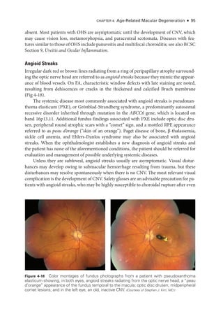 Chapter 4: Age-­
Related Macular Degeneration ● 95
absent. Most patients with OHS are asymptomatic ­
until the development of CNV, which
may cause vision loss, metamorphopsia, and paracentral scotomata. Diseases with fea-
tures similar to ­those of OHS include panuveitis and multifocal choroiditis; see also BCSC
Section 9, Uveitis and Ocular Inflammation.
Angioid Streaks
Irregular dark red or brown lines radiating from a ring of peripapillary atrophy surround-
ing the optic nerve head are referred to as angioid streaks ­
because they mimic the appear-
ance of blood vessels. On FA, characteristic win­
dow defects with late staining are noted,
resulting from dehiscences or cracks in the thickened and calcified Bruch membrane
(Fig 4-18).
The systemic disease most commonly associated with angioid streaks is pseudoxan-
thoma elasticum (PXE), or Grönblad-­
Strandberg syndrome, a predominantly autosomal
recessive disorder inherited through mutation in the ABCC6 gene, which is located on
band 16p13.11. Additional fundus findings associated with PXE include optic disc dru-
sen, peripheral round atrophic scars with a “comet” sign, and a mottled RPE appearance
referred to as peau d’orange (“skin of an orange”). Paget disease of bone, β-­thalassemia,
sickle cell anemia, and Ehlers-­
Danlos syndrome may also be associated with angioid
streaks. When the ophthalmologist establishes a new diagnosis of angioid streaks and
the patient has none of the aforementioned conditions, the patient should be referred for
evaluation and management of pos­
si­
ble under­
lying systemic diseases.
­
Unless they are subfoveal, angioid streaks usually are asymptomatic. Visual distur-
bances may develop owing to submacular hemorrhage resulting from trauma, but ­
these
disturbances may resolve spontaneously when ­
there is no CNV. The most relevant visual
complication is the development of CNV. Safety glasses are an advisable precaution for pa-
tients with angioid streaks, who may be highly susceptible to choroidal rupture ­
after even
Figure 4-18 Color montages of fundus photo­
graphs from a patient with pseudoxanthoma
elasticum showing, in both eyes, angioid streaks radiating from the optic nerve head; a “peau
d’orange” appearance of the fundus temporal to the macula; optic disc drusen; midperipheral
comet lesions; and in the left eye, an old, inactive CNV. (Courtesy of Stephen J. Kim, MD.)
 