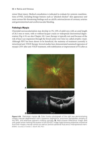 96 ● Retina and Vitreous
A
B 200 μm
200 μm
Figure 4-19 Pathologic myopia. A, Color fundus photo­
graph of the right eye demonstrating
myopic macular degeneration with a posterior staphyloma, prominent peripapillary atrophy of
the RPE, and extensive pigment mottling centrally. B, Near-­
infrared reflectance image (left)
with green arrow marking the location of the SD-­
OCT image (right) showing extensive intraret­
i­
nal
fluid with myopic macular schisis as well as central subret­
i­
nal fluid and a mild epiret­
i­
nal mem-
brane. (Courtesy of Charles C. Wykoff, MD, PhD.)
minor blunt injury. Medical consultation is indicated to evaluate for systemic manifesta-
tions of PXE, including benign features such as “plucked chicken” skin appearance and
more serious life-­
threatening findings such as calcific arteriosclerosis of coronary arteries
and gastrointestinal and cerebrovascular bleeding.
Pathologic Myopia
Choroidal neovascularization may develop in 5%–10% of adult eyes with an axial length
of 26.5 mm or more, with or without lacquer cracks or widespread chorioret­
i­
nal degen-
eration (Fig 4-19; see also Chapter 10). ­
Laser therapy is typically not used ­
because of the
risk of ­
laser scar expansion through the foveal center over time (so-­
called atrophic creep).
Although PDT has been shown to be beneficial, the mainstay of treatment currently is
intravitreal anti-­VEGF therapy. Several studies have demonstrated sustained regression of
myopic CNV ­
after anti-­
VEGF treatment, with stabilization or improvement of VA ­
after as
 