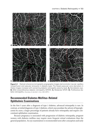 Chapter 5: Diabetic Retinopathy ● 103
Recommended Diabetes Mellitus–­
Related
Ophthalmic Examinations
In the first 5 years ­
after a diagnosis of type 1 diabetes, advanced retinopathy is rare. In
contrast, at initial diagnosis of type 2 diabetes, which may postdate the advent of hypergly-
cemia by years, a larger percentage of patients already have retinopathy and require con-
comitant ophthalmic examination.
­
Because pregnancy is associated with progression of diabetic retinopathy, pregnant
­
women with diabetes mellitus may require more frequent ret­
i­
nal evaluations than the
general population. An eye examination is recommended soon ­
after conception and early
A B
D
C
Figure 5-1 Optical coherence tomography angiography images demonstrate macular capillary
nonperfusion and vascular tortuosity in diabetic eyes. The foveal avascular zone dia­
meters in
­
these images increase with worsening diabetic retinopathy severity level. A, Nondiabetic eye.
B, Mild nonproliferative diabetic retinopathy (NPDR). C, Moderate NPDR. D, Proliferative dia-
betic retinopathy. (Courtesy of Jennifer K. Sun, MD, MPH.)
 