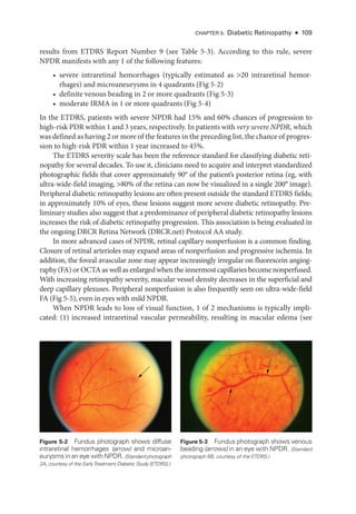 Chapter 5: Diabetic Retinopathy ● 109
results from ETDRS Report Number 9 (see ­
Table 5-3). According to this rule, severe
NPDR manifests with any 1 of the following features:
• severe intraret­
i­
nal hemorrhages (typically estimated as 20 intraret­i­nal hemor-
rhages) and microaneurysms in 4 quadrants (Fig 5-2)
• definite venous beading in 2 or more quadrants (Fig 5-3)
• moderate IRMA in 1 or more quadrants (Fig 5-4)
In the ETDRS, patients with severe NPDR had 15% and 60% chances of progression to
high-­risk PDR within 1 and 3 years, respectively. In patients with very severe NPDR, which
was defined as having 2 or more of the features in the preceding list, the chance of progres-
sion to high-­
risk PDR within 1 year increased to 45%.
The ETDRS severity scale has been the reference standard for classifying diabetic reti-
nopathy for several de­
cades. To use it, clinicians need to acquire and interpret standardized
photographic fields that cover approximately 90° of the patient’s posterior ret­
ina (eg, with
ultra-­wide-­field imaging, 80% of the ret­
ina can now be visualized in a single 200° image).
Peripheral diabetic retinopathy lesions are often pre­
sent outside the standard ETDRS fields;
in approximately 10% of eyes, ­
these lesions suggest more severe diabetic retinopathy. Pre-
liminary studies also suggest that a predominance of peripheral diabetic retinopathy lesions
increases the risk of diabetic retinopathy progression. This association is being evaluated in
the ongoing DRCR Ret­
ina Network (DRCR​.­net) Protocol AA study.
In more advanced cases of NPDR, ret­
i­
nal capillary nonperfusion is a common finding.
Closure of ret­
i­
nal arterioles may expand areas of nonperfusion and progressive ischemia. In
addition, the foveal avascular zone may appear increasingly irregular on fluorescein angiog-
raphy (FA) or OCTA as well as enlarged when the innermost capillaries become nonperfused.
With increasing retinopathy severity, macular vessel density decreases in the superficial and
deep capillary plexuses. Peripheral nonperfusion is also frequently seen on ultra-­
wide-­
field
FA (Fig 5-5), even in eyes with mild NPDR.
When NPDR leads to loss of visual function, 1 of 2 mechanisms is typically impli-
cated: (1) increased intraret­
i­
nal vascular permeability, resulting in macular edema (see
Figure 5-2 Fundus photo­
graph shows diffuse
intraret­i­nal hemorrhages (arrow) and microan-
eurysms in an eye with NPDR. (Standard photo­graph
2A, courtesy of the EarlyTreatment Diabetic Study [ETDRS].)
Figure 5-3 Fundus photo­
graph shows venous
beading (arrows) in an eye with NPDR. (Standard
photo­
graph 6B, courtesy of the ETDRS.)
 