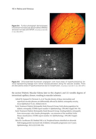 110 ● Retina and Vitreous
the section Diabetic Macular Edema ­
later in this chapter); and (2) variable degrees of
intra­
ret­
i­
nal capillary closure, resulting in macular ischemia.
Ashraf M, Sampani K, Clermont A, et al. Vascular density of deep, intermediate and
superficial vascular plexuses are differentially affected by diabetic retinopathy severity.
Invest Ophthalmol Vis Sci. 2020;61(10):53.
Early Treatment Diabetic Retinopathy Study Research Group. Early photocoagulation for
diabetic retinopathy. ETDRS report number 9. Ophthalmology. 1991;98(5 Suppl):766–785.
Early Treatment Diabetic Retinopathy Study Research Group. Grading diabetic retinopathy
from stereoscopic color fundus photo­
graphs—an extension of the modified Airlie
House classification. ETDRS report number 10. Ophthalmology. 1991;98(5 Suppl):​
786–806.
Silva PS, Cavallerano JD, Haddad NM, et al. Peripheral lesions identified on ultrawide
field imaging predict increased risk of diabetic retinopathy progression over 4 years.
Ophthalmology. 2015;122(5):949–956.
Figure 5-4 Fundus photo­
graph demonstrates
intraret­
i­
nal microvascular abnormalities (IRMAs)
(arrows) in an eye with NPDR. (Courtesy of Jennifer
K. Sun, MD, MPH.)
Figure 5-5 Ultra-­
wide-­
field fluorescein angiogram with focal areas of hyperfluorescence (ar­
rows) representing leakage from ret­
i­
nal neovascularization along the vascular arcades. ­
There
are also patchy areas of hypofluorescence due to nonperfusion. (Courtesy of Jennifer K. Sun, MD, MPH.)
 
