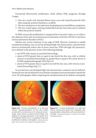 114 ● Retina and Vitreous
Extraret­
i­
nal fibrovascular proliferation, which defines PDR, progresses through
3 stages:
1. Fine new vessels with minimal fibrous tissue cross and extend beyond the ILM,
often using the posterior hyaloid as a scaffold.
2. The new vessels grow in size and extent, developing an increased fibrous component.
3. The new vessels regress, leaving residual fibrovascular tissue that may be tethered
within the posterior hyaloid.
In PDR, neovascular proliferation is categorized by its location: ­
either on or within a
disc dia­meter of the optic nerve head (neovascularization of the disc [NVD]) or elsewhere
(neovascularization elsewhere [NVE]).
Patients may receive treatment at any stage of PDR. However, treatment is usually
considered mandatory once an eye has developed high-­
risk characteristics, and it has been
shown to dramatically reduce rates of severe vision loss. PDR with high-­
risk characteris-
tics is defined as the presence of any of the following findings:
• any NVD with vitreous or preret­
i­
nal hemorrhage
• extent of NVD greater than or equal to one-­
fourth the disc area, with or without
vitreous or preret­
i­
nal hemorrhage (ie, greater than or equal to the extent shown in
ETDRS standard photo­
graph 10A) (Fig 5-6)
• extent of NVE greater than or equal to one-­
half the disc area, with vitreous or pre­
ret­i­nal hemorrhage (Fig 5-7)
In eyes that have not developed high-­
risk characteristics, treatment may be deferred.
Treatment may also be deferred in eyes that have peripheral neovascularization outside the
seven 30° photographic fields comprising the standard protocol for diabetic retinopathy
Figure 5-6 Fundus photo­
graph of a left eye
shows neovascularization of the disc (NVD,
arrow) with a small amount of vitreous hemor-
rhage. Even without vitreous hemorrhage, this
degree of neovascularization is the lower limit
of moderate NVD and is considered high-­
risk
proliferative diabetic retinopathy. (Standard photo­
graph 10A, courtesy of the Diabetic Retinopathy Study.)
Figure 5-7 Fundus photo­
graph of a right eye
shows cotton-­
wool spots and moderate neo-
vascularization elsewhere with preret­
i­
nal hem-
orrhage. (Standard photo­
graph 7
, courtesy of the Diabetic
Retinopathy Study.)
 