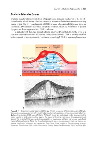Chapter 5: Diabetic Retinopathy ● 121
Diabetic Macular Edema
Diabetic macular edema results from a hyperglycemia-­
induced breakdown of the blood–­
retina barrier, which leads to fluid extravasation from ret­
i­
nal vessels into the surrounding
neural ret­
ina (Fig 5-11). A diagnosis of DME is made when ret­
i­
nal thickening involves
the macula. DME may be associated with hard exudates, which are precipitates of plasma
lipoproteins that may persist ­
after DME resolution.
In patients with diabetes, central subfield–­
involved DME that affects the fovea is a
common cause of vision loss. In contrast, non–­
center-­
involved DME is unlikely to affect
vision ­
unless it progresses to center involvement. Although DME is increasingly common
A
Microaneurysm
Exudate
Exudate
Swollen retina
Normal retina
Normal capillary
Retinal pigment epithelium
Damaged
capillary
OR
B
Figure 5-11 Diabetic macular edema (DME). A, Artist’s rendering of the mechanism of DME,
demonstrating development of ret­
i­
nal thickening from a breakdown of the blood–­
retina barrier.
B, Spectral-­
domain OCT scan of DME. Although ­
there are extensive cystic changes in the
outer plexiform and outer nuclear layers, the external limiting membrane line appears intact
across the extent of the scan, with the exception of shadowing artifacts from more superficial
hyperreflective lesions. Note the foveal detachment. (Part A from Ginsburg LH, Aiello LM. Diabetic reti­
nopathy: classification, progression, and management. Focal Points: Clinical Modules for Ophthalmologists. American
Acad­
emy of Ophthalmology; 1993, module 7
. Illustration by Christine Gralapp. Part B courtesy of Colin A. McCannel, MD.)
 