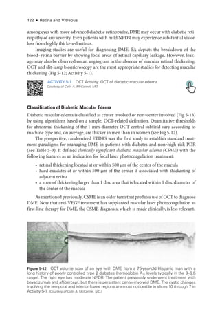 122 ● Retina and Vitreous
among eyes with more advanced diabetic retinopathy, DME may occur with diabetic reti-
nopathy of any severity. Even patients with mild NPDR may experience substantial vision
loss from highly thickened ret­
i­
nas.
Imaging studies are useful for diagnosing DME. FA depicts the breakdown of the
blood–­
retina barrier by showing local areas of ret­
i­
nal capillary leakage. However, leak-
age may also be observed on an angiogram in the absence of macular ret­
i­
nal thickening.
OCT and slit-­
lamp biomicroscopy are the most appropriate studies for detecting macular
thickening (Fig 5-12; Activity 5-1).
ACTIVITY 5-1 OCT Activity: OCT of diabetic macular edema.
Courtesy of Colin A. McCannel, MD.
Classification of Diabetic Macular Edema
Diabetic macular edema is classified as center involved or non‒center involved (Fig 5-13)
by using algorithms based on a ­
simple, OCT-­
related definition. Quantitative thresholds
for abnormal thickening of the 1-­
mm-dia­
meter OCT central subfield vary according to
machine type and, on average, are thicker in men than in ­
women (see Fig 5-12).
The prospective, randomized ETDRS was the first study to establish standard treat-
ment paradigms for managing DME in patients with diabetes and non‒high-­
risk PDR
(see ­
Table 5-3). It defined clinically significant diabetic macular edema (CSME) with the
following features as an indication for focal ­
laser photocoagulation treatment:
• ret­
i­
nal thickening located at or within 500 µm of the center of the macula
• hard exudates at or within 500 µm of the center if associated with thickening of
adjacent ret­ina
• a zone of thickening larger than 1 disc area that is located within 1 disc dia­
meter of
the center of the macula
As mentioned previously, CSME is an older term that predates use of OCT to diagnose
DME. Now that anti-­
VEGF treatment has supplanted macular ­
laser photocoagulation as
first-­
line therapy for DME, the CSME diagnosis, which is made clinically, is less relevant.
Figure 5-12 OCT volume scan of an eye with DME from a 75-­
year-­
old Hispanic man with a
long history of poorly controlled type 2 diabetes (hemoglobin A1c levels typically in the 9–9.6
range). The right eye has moderate NPDR. The patient previously underwent treatment with
bevacizumab and aflibercept, but ­
there is per­
sis­
tent center-­
involved DME. The cystic changes
involving the temporal and inferior foveal regions are most noticeable in slices 10 through 7 in
Activity 5-1. (Courtesy of Colin A. McCannel, MD.)
 