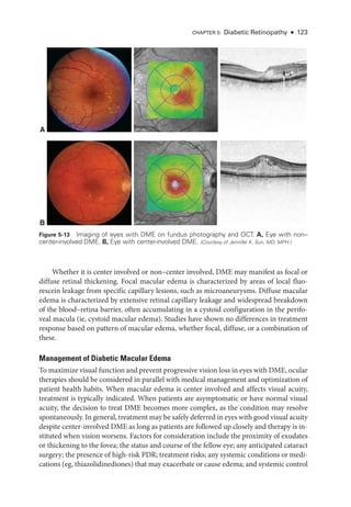 Chapter 5: Diabetic Retinopathy ● 123
­
Whether it is center involved or non–­
center involved, DME may manifest as focal or
diffuse ret­
i­
nal thickening. Focal macular edema is characterized by areas of local fluo-
rescein leakage from specific capillary lesions, such as microaneurysms. Diffuse macular
edema is characterized by extensive ret­
i­
nal capillary leakage and widespread breakdown
of the blood–­
retina barrier, often accumulating in a cystoid configuration in the perifo-
veal macula (ie, cystoid macular edema). Studies have shown no differences in treatment
response based on pattern of macular edema, ­
whether focal, diffuse, or a combination of
­these.
Management of Diabetic Macular Edema
To maximize visual function and prevent progressive vision loss in eyes with DME, ocular
therapies should be considered in parallel with medical management and optimization of
patient health habits. When macular edema is center involved and affects visual acuity,
treatment is typically indicated. When patients are asymptomatic or have normal visual
acuity, the decision to treat DME becomes more complex, as the condition may resolve
spontaneously. In general, treatment may be safely deferred in eyes with good visual acuity
despite center-­
involved DME as long as patients are followed up closely and therapy is in-
stituted when vision worsens. ­
Factors for consideration include the proximity of exudates
or thickening to the fovea; the status and course of the fellow eye; any anticipated cataract
surgery; the presence of high-­
risk PDR; treatment risks; any systemic conditions or medi­
cations (eg, thiazolidinediones) that may exacerbate or cause edema; and systemic control
A
B
200 μm 200 μm
200 μm 200 μm
Figure 5-13 Imaging of eyes with DME on fundus photography and OCT. A, Eye with non–­
center-­involved DME. B, Eye with center-­
involved DME. (Courtesy of Jennifer K. Sun, MD, MPH.)
 
