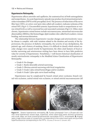 132 ● Retina and Vitreous
Hypertensive Retinopathy
Hypertension affects arterioles and capillaries, the anatomical loci of both autoregulation
and nonperfusion. An acute hypertensive episode may produce focal intraret­i­nal periarte-
riolar transudates (FIPTs) at the precapillary level. The presence of infarctions of the nerve
fiber layer (NFL), or cotton-­wool spots (also called soft exudates), indicates ischemia of the
ret­i­nal NFL (Fig 6-1). Uncontrolled systemic hypertension leads to nonperfusion at vari­
ous ret­
i­
nal levels as well as neuronal loss and associated scotomata (Fig 6-2). Other, more
chronic, hypertensive ret­
i­
nal lesions include microaneurysms, intraret­
i­
nal microvascular
abnormalities (IRMAs), blot hemorrhages, lipid exudates (also called hard exudates), venous
beading, and neovascularization.
The relationship between hypertensive vascular changes and arteriosclerotic vascu-
lar disease is complex, with wide variation related to the duration and severity of the hy-
pertension, the presence of diabetic retinopathy, the severity of any dyslipidemia, the
patient’s age, and a history of smoking. Hence, it is difficult to classify which ret­
i­
nal vas-
cular changes ­
were caused strictly by hypertension; the often-­
cited features of focal ar-
teriolar narrowing and arteriovenous nicking have been shown to have ­
little predictive
value for severity of hypertension. Nonetheless, 1 well-­
known historical classification of
mostly arteriosclerotic retinopathy is the Modified Scheie Classification of Hypertensive
Retinopathy:
• Grade 0: No changes
• Grade 1: Barely detectable arterial narrowing
• Grade 2: Obvious arterial narrowing with focal irregularities
• Grade 3: Grade 2 plus ret­
i­
nal hemorrhages and/or exudates
• Grade 4: Grade 3 plus optic nerve head swelling
Hypertension may be complicated by branch ret­
i­
nal artery occlusion, branch ret­
i­
nal vein occlusion, central ret­
i­
nal vein occlusion, or ret­
i­
nal arterial macroaneurysms (all
A B
Figure 6-1 Severe hypertensive retinopathy. A, Fundus photo­
graph from a 25-­
year-­
old man
with renal hypertension shows large, superficial, white cotton-­
wool spots (arrows) contrasting
with small, deep, tan focal intraret­
i­
nal periarteriolar transudates (FIPTs, arrowheads). B, Angi­og­
raphy image shows areas of nonperfusion corresponding to the cotton-­
wool spots and punctate
hyperfluorescence corresponding to the FIPTs. (Courtesy of Hermann D. Schubert, MD.)
 
