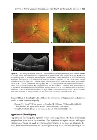 CHAPTER 6: Ret­
i­
nal Vascular Diseases Associated With Cardiovascular Disease ● 133
discussed ­
later in this chapter). In addition, the coexistence of hypertension and diabetes
results in more severe retinopathy.
Cheung CYL, Wong TY. Hypertension. In: Schachat AP, Wilkinson CP, Hinton DR, Sadda SR,
Wiedemann P, eds. Ryan’s Ret­i­na. 6th ed. Elsevier/Saunders; 2018:chap 52.
Wong TY, Mitchell P. The eye in hypertension. Lancet. 2007;369(9559):425–435.
Hypertensive Choroidopathy
Hypertensive choroidopathy typically occurs in young patients who have experienced
an episode of acute, severe hypertension, often associated with preeclampsia, eclampsia,
pheochromocytoma, or renal hypertension (see Chapter 9 for more on choroidal dis-
ease). Lobular nonperfusion of the choriocapillaris may occur, initially resulting in tan,
Figure 6-2 Acute hypertensive episode. This 40-­
year-­
old patient presented with several weeks
of blurred vision and headache. Blood pressure at pre­
sen­
ta­
tion was 245/150 mm Hg. A, B, Fun-
dus photo­
graphs of the right and left eyes, respectively, show ele­
ments of both retinopathy
and optic neuropathy: optic nerve head edema, dilated capillaries on the nerve head, flame-­
shaped nerve fiber layer (NFL) hemorrhages, cotton-­
wool spots, macular exudates, and subret­
i­nal fluid. C, Optical coherence tomography (OCT) of the right macula shows fluid in the NFL,
ret­ina, and subret­i­nal space. D, Photo­
graph of the left fundus 3 months ­
later, after initiation
of systemic antihypertensive medi­
cations, shows resolution of optic nerve head edema and
reduction in ret­
i­
nal exudation and hemorrhage. Blood pressure at this visit was 197/99 mm Hg.
(Parts A and B courtesy of Jeremy Anderson, OD, and parts C and D courtesy of Franco M. Recchia, MD.)
T
10
S
N
A B
C D
 