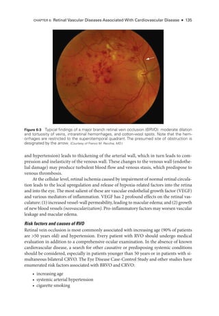 Figure 6-3 Typical findings of a major branch ret­
i­
nal vein occlusion (BRVO): moderate dilation
and tortuosity of veins, intraret­
i­
nal hemorrhages, and cotton-­
wool spots. Note that the hem-
orrhages are restricted to the superotemporal quadrant. The presumed site of obstruction is
designated by the arrow. (Courtesy of Franco M. Recchia, MD.)
and hypertension) leads to thickening of the arterial wall, which in turn leads to com-
pression and inelasticity of the venous wall. ­
These changes to the venous wall (endothe-
lial damage) may produce turbulent blood flow and venous stasis, which predispose to
venous thrombosis.
At the cellular level, ret­
i­
nal ischemia caused by impairment of normal ret­
i­
nal circula-
tion leads to the local upregulation and release of hypoxia-­
related ­
factors into the ret­
ina
and into the eye. The most salient of ­
these are vascular endothelial growth ­
factor (VEGF)
and vari­
ous mediators of inflammation. VEGF has 2 profound effects on the ret­
i­
nal vas-
culature: (1) increased vessel-­wall permeability, leading to macular edema; and (2) growth
of new blood vessels (neovascularization). Pro-­
inflammatory ­
factors may worsen vascular
leakage and macular edema.
Risk ­
factors and ­
causes of RVO
Ret­
i­
nal vein occlusion is most commonly associated with increasing age (90% of patients
are 50 years old) and hypertension. ­
Every patient with RVO should undergo medical
evaluation in addition to a comprehensive ocular examination. In the absence of known
cardiovascular disease, a search for other causative or predisposing systemic conditions
should be considered, especially in patients younger than 50 years or in patients with si-
multaneous bilateral CRVO. The Eye Disease Case-­
Control Study and other studies have
enumerated risk ­
factors associated with BRVO and CRVO:
• increasing age
• systemic arterial hypertension
• cigarette smoking
CHAPTER 6: Ret­
i­
nal Vascular Diseases Associated With Cardiovascular Disease ● 135
 