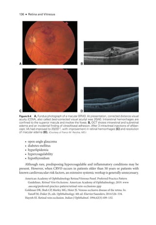 136 ● Retina and Vitreous
• open-­angle glaucoma
• diabetes mellitus
• hyperlipidemia
• hypercoagulability
• hypothyroidism
Although rare, predisposing hypercoagulable and inflammatory conditions may be
pre­
sent. However, when CRVO occurs in patients older than 50 years or patients with
known cardiovascular risk ­factors, an extensive systemic workup is generally unnecessary.
American Acad­
emy of Ophthalmology Ret­
i­
na/Vitreous Panel. Preferred Practice Pattern
Guidelines. Ret­i­nal Vein Occlusions. American Acad­
emy of Ophthalmology; 2019. www​
.­aao​.­org​/­preferred​-­practice​-­pattern​/­retinal​-­vein​-­occlusions​-­ppp
Goldman DR, Shah CP, Morley MG, Heier JS. Venous occlusive disease of the ret­
ina. In:
Yanoff M, Duker JS, eds. Ophthalmology. 4th ed. Elsevier/Saunders; 2014:526–534.
Hayreh SS. Ret­
i­
nal vein occlusion. Indian J Ophthalmol. 1994;42(3):109–132.
A
C D
B
Figure 6-4 A, Fundus photo­
graph of a macular BRVO. At pre­
sen­
ta­
tion, corrected distance visual
acuity (CDVA; also called best-­
corrected visual acuity) was 20/40. Intraret­
i­
nal hemorrhages are
confined to the superior macula and involve the fovea. B, OCT shows intraret­
i­
nal and subret­
i­
nal
edema and an incidental finding of vitreofoveal adhesion. ­
After 3 intravitreal injections of afliber-
cept, VA had improved to 20/20−2
, with improvement in ret­
i­
nal hemorrhages (C) and resolution
of macular edema (D). (Courtesy of Franco M. Recchia, MD.)
 