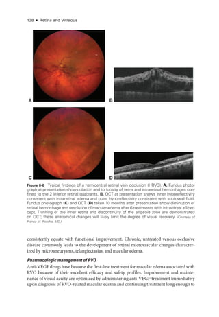 138 ● Retina and Vitreous
consistently equate with functional improvement. Chronic, untreated venous occlusive
disease commonly leads to the development of ret­
i­
nal microvascular changes character-
ized by microaneurysms, telangiectasias, and macular edema.
Pharmacologic management of RVO
Anti-­VEGF drugs have become the first-­line treatment for macular edema associated with
RVO ­
because of their excellent efficacy and safety profiles. Improvement and mainte-
nance of visual acuity are optimized by administering anti-­
VEGF treatment immediately
upon diagnosis of RVO-­
related macular edema and continuing treatment long enough to
A
C D
B
Figure 6-6 Typical findings of a hemicentral ret­
i­
nal vein occlusion (HRVO). A, Fundus photo­
graph at pre­
sen­
ta­
tion shows dilation and tortuosity of veins and intraret­
i­
nal hemorrhages con-
fined to the 2 inferior ret­
i­
nal quadrants. B, OCT at pre­
sen­
ta­
tion shows inner hyporeflectivity
consistent with intraret­
i­
nal edema and outer hyporeflectivity consistent with subfoveal fluid.
Fundus photo­graph (C) and OCT (D) taken 10 months ­
after pre­
sen­
ta­
tion show diminution of
ret­
i­
nal hemorrhage and resolution of macular edema ­
after 6 treatments with intravitreal afliber-
cept. Thinning of the inner ret­
ina and discontinuity of the ellipsoid zone are demonstrated
on OCT; ­
these anatomical changes ­
will likely limit the degree of visual recovery. (Courtesy of
Franco M. Recchia, MD.)
 