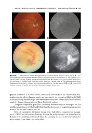prevent recurrence of macular edema. Intraocular corticosteroids are also effective at re-
ducing macular edema. ­
Because studies are increasingly not separating BRVO and CRVO
when evaluating pharmacologic treatment of macular edema secondary to ret­
i­
nal venous
occlusive disease, they are discussed together in this section.
­
Laser photocoagulation, pars plana vitrectomy, and other surgical techniques are also
used in selected cases of BRVO and CRVO. See the discussions of surgical management in
the specific sections for ­
those entities.
­
Table 6-1 summarizes the major clinical ­
trials that inform con­
temporary manage-
ment of RVO and their salient findings. ­
Because the study acronyms are generally more
familiar to readers than are the study titles, the acronyms are used in the chapter text; for
the complete titles, please refer to the ­
table.
Figure 6-7 Characteristic ret­
i­
nal changes seen in a chronic ret­
i­
nal vein occlusion (RVO). A, Color
photo­
graph shows collateral vessels (specifically optociliary shunt vessels) on the superior optic
nerve head, macular atrophy, and epiret­
i­
nal membrane. B, Corresponding fluorescein angiogram
shows areas of nonperfusion, telangiectasias, and mild macular edema.The collateral optic nerve
head vessels can be contrasted with neovascularization of the disc shown in C and D. (Parts A and B
courtesy of Franco M. Recchia, MD; parts C and D courtesy of Gary C. Brown, MD.)
A
C D
B
CHAPTER 6: Ret­
i­
nal Vascular Diseases Associated With Cardiovascular Disease ● 139
 