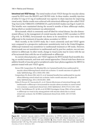 144 ● Retina and Vitreous
Intravitreal anti-­VEGF therapy The initial studies of anti-­VEGF therapy for macular edema
caused by RVO ­
were the BRAVO and CRUISE ­
trials. In ­
these studies, monthly injection
of ­
either 0.5 mg or 0.3 mg of ranibizumab was superior to sham injection for improving
visual acuity. Similar results ­
were achieved with intravitreal aflibercept (also called VEGF
Trap-­Eye) in the VIBRANT, COPERNICUS, and GALILEO studies (see Figs 6-4 and 6-6).
The benefits ­
were maintained during the second 6 months of ­
these aflibercept studies,
during which as-­
needed treatment was administered.
Bevacizumab, which is commonly used off label for ret­
i­
nal disease, has also demon-
strated efficacy in the management of cystoid macular edema (CME) secondary to RVO
(Fig 6-8). In SCORE2, bevacizumab was shown to be noninferior to (not worse than)
aflibercept in the treatment of macular edema secondary to CRVO.
More recently, in the LEAVO study, the 3 most commonly used anti-­
VEGF agents
­
were compared in a prospective multicenter noninferiority trial in the United Kingdom.
Aflibercept treatment was noninferior to ranibizumab treatment at 100 weeks. However,
bevacizumab was not noninferior to ranibizumab and, by post hoc analy­
sis, was not non-
inferior to aflibercept. In other words, change in visual acuity may be worse with the use
of bevacizumab than with the use of ranibizumab or aflibercept.
In current clinical practice, anti-­
VEGF regimens for RVO include fixed monthly dos-
ing, as-­
needed treatment, and treat-­
and-­
extend approaches. Clinical ­
trials have shown no
additive benefit of macular grid or peripheral scatter ­
laser photocoagulation for BRVO in
patients treated with anti-­
VEGF agents.
Brown DM, Campochiaro PA, Bhisitkul RB, et al. Sustained benefits from ranibizumab for
macular edema following branch ret­
i­
nal vein occlusion: 12-­
month outcomes of a phase III
study. Ophthalmology. 2011;118(8):1594–1602.
Campochiaro PA, Brown DM, Awh CC, et al. Sustained benefits from ranibizumab for macular
edema following central ret­
i­
nal vein occlusion: twelve-­
month outcomes of a phase III
study. Ophthalmology. 2011;118(10):2041–2049.
Hykin P, Prevost AT, Vasconcelos JC, et al. Clinical effectiveness of intravitreal therapy with
ranibizumab vs aflibercept vs bevacizumab for macular edema secondary to central ret­
i­
nal
vein occlusion: a randomized clinical trial. JAMA Ophthalmol. 2019;137(11):1256–1264.
Scott IU, VanVeldhuisen PC, Ip MS, et al; SCORE2 Investigator Group. Effect of bevacizumab
vs aflibercept on visual acuity among patients with macular edema due to central
ret­
i­
nal vein occlusion: the SCORE2 randomized clinical trial. JAMA. 2017;317(20):
2072–2087.
A B
Figure 6-8 Cystoid macular edema (CME) secondary to CRVO, before and ­
after treatment.
A, Spectral-­
domain OCT (SD-­
OCT) scan shows severe CME with foveal detachment in a pa-
tient with a nonischemic CRVO. VA was 20/200. B, One month ­
after intravitreal injection of
bevacizumab 1.25 mg, the cystic changes and foveal detachment resolved, and VA was 20/25.
(Courtesy of Colin A. McCannel, MD.)
 