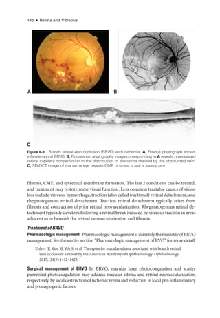 146 ● Retina and Vitreous
fibrosis, CME, and epiret­
i­
nal membrane formation. The last 2 conditions can be treated,
and treatment may restore some visual function. Less common treatable ­
causes of vision
loss include vitreous hemorrhage, traction (also called tractional) ret­
i­
nal detachment, and
rhegmatogenous ret­
i­
nal detachment. Traction ret­
i­
nal detachment typically arises from
fibrosis and contraction of prior ret­
i­
nal neovascularization. Rhegmatogenous ret­
i­
nal de-
tachment typically develops following a ret­i­nal break induced by vitreous traction in areas
adjacent to or beneath the ret­
i­
nal neovascularization and fibrosis.
Treatment of BRVO
Pharmacologic management PharmacologicmanagementiscurrentlythemainstayofBRVO
management. See the ­
earlier section “Pharmacologic management of RVO” for more detail.
Ehlers JP, Kim SJ, Yeh S, et al. Therapies for macular edema associated with branch ret­
i­
nal
vein occlusion: a report by the American Acad­
emy of Ophthalmology. Ophthalmology.
2017;124(9):1412–1423.
Surgical management of BRVO In BRVO, macular ­
laser photocoagulation and scatter
panret­
i­
nal photocoagulation may address macular edema and ret­
i­
nal neovascularization,
respectively, by local destruction of ischemic ret­ina and reduction in local pro-­inflammatory
and proangiogenic ­
factors.
A
C
B
Figure 6-9 Branch ret­
i­
nal vein occlusion (BRVO) with ischemia. A, Fundus photo­
graph shows
inferotemporal BRVO. B, Fluorescein angiography image corresponding to A reveals pronounced
ret­
i­
nal capillary nonperfusion in the distribution of the ret­
ina drained by the obstructed vein.
C, SD-­
OCT image of the same eye reveals CME. (Courtesy of Neal H. Atebara, MD.)
 