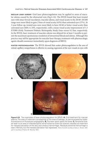 macular ­
laser surgery Grid ­
laser photocoagulation may be applied to areas of macu-
lar edema caused by the obstructed vein (Fig 6-10). The BVOS found that laser-­
treated
eyes with intact foveal vasculature, macular edema, and visual acuity in the 20/40–20/200
range ­
were more likely to gain 2 lines of visual acuity (65%) than untreated eyes (37%). At
3-­
year follow-up, treated eyes ­
were more likely to have 20/40 or better visual acuity than
untreated eyes (60% vs 34%, respectively), with a mean visual acuity improvement of 1.3
ETDRS (Early Treatment Diabetic Retinopathy Study) lines versus 0.2 line, respectively.
In the BVOS, ­
laser treatment of macular edema was delayed for at least 3 months to per-
mit the maximum spontaneous resolution of intraret­
i­
nal blood and edema. Although this
practice may still be appropriate for macular ­
laser therapy, treatment with pharmacologic
agents should commence immediately upon diagnosis of BRVO.
scatter photocoagulation The BVOS showed that scatter photocoagulation to the area of
ret­
i­
nal capillary nonperfusion is effective in causing regression of the new vessels in eyes with
A B
C
Figure 6-10 Two examples of ­
laser photocoagulation for BRVO. A, Grid treatment for macular
edema. The area of treatment corresponds to the area of leakage, as demonstrated by hyper-
fluorescence on fluorescein angiography. B,The ­
laser spots spare the fovea. C, Peripheral scat-
ter ­
laser to an area of inferotemporal ret­
i­
nal ischemia (note the sclerotic vessels) as treatment
for neovascularization of the disc and vitreous hemorrhage. Residual preret­
i­
nal hemorrhage is
seen inferiorly, but the neovascularization has regressed. (Parts A and B courtesy of Gary C. Brown, MD;
part C courtesy of Franco M. Recchia, MD.)
CHAPTER 6: Ret­
i­
nal Vascular Diseases Associated With Cardiovascular Disease ● 147
 