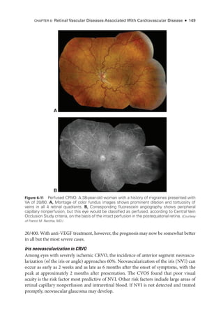 20/400. With anti-­
VEGF treatment, however, the prognosis may now be somewhat better
in all but the most severe cases.
Iris neovascularization in CRVO
Among eyes with severely ischemic CRVO, the incidence of anterior segment neovascu-
larization (of the iris or ­
angle) approaches 60%. Neovascularization of the iris (NVI) can
occur as early as 2 weeks and as late as 6 months ­
after the onset of symptoms, with the
peak at approximately 2 months ­
after pre­
sen­
ta­
tion. The CVOS found that poor visual
acuity is the risk ­
factor most predictive of NVI. Other risk ­
factors include large areas of
ret­
i­
nal capillary nonperfusion and intraret­
i­
nal blood. If NVI is not detected and treated
promptly, neovascular glaucoma may develop.
A
B
Figure 6-11 Perfused CRVO. A 38-­
year-­
old ­
woman with a history of migraines presented with
VA of 20/80. A, Montage of color fundus images shows prominent dilation and tortuosity of
veins in all 4 ret­
i­
nal quadrants. B, Corresponding fluorescein angiography shows peripheral
capillary nonperfusion, but this eye would be classified as perfused, according to Central Vein
Occlusion Study criteria, on the basis of the intact perfusion in the postequatorial ret­
ina. (Courtesy
of Franco M. Recchia, MD.)
CHAPTER 6: Ret­
i­
nal Vascular Diseases Associated With Cardiovascular Disease ● 149
 