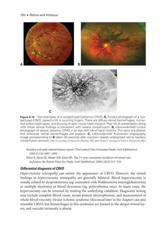 150 ● Retina and Vitreous
Baseline and early natu­
ral history report. The Central Vein Occlusion Study. Arch Ophthalmol.
1993;111(8):1087–1095.
Klein R, Moss SE, Meuer SM, Klein BE. The 15-­
year cumulative incidence of ret­
i­
nal vein
occlusion: the Beaver Dam Eye Study. Arch Ophthalmol. 2008;126(4):513–518.
Differential diagnosis of CRVO
Hyperviscosity retinopathy can mimic the appearance of CRVO. However, the ret­
i­
nal
findings in hyperviscosity retinopathy are generally bilateral. Blood hyperviscosity is
usually related to dysproteinemia (eg, associated with Waldenström macroglobulinemia
or multiple myeloma) or blood dyscrasias (eg, polycythemia vera). In many cases, the
hyperviscosity can be reversed by treating the under­
lying condition. Diagnostic testing
may include complete blood count, serum protein electrophoresis, and mea­
sure­
ment of
whole-­blood viscosity. Ocular ischemic syndrome (discussed ­
later in the chapter) can also
resemble CRVO, but hemorrhages in this syndrome are ­
limited to the deeper ret­
i­
nal lay-
ers, and vascular tortuosity is absent.
C
B
A
Figure 6-12 Two examples of a nonperfused (ischemic) CRVO. A, Fundus photo­
graph of a non-
perfused CRVO; patient’s VA is counting fin­
gers. ­
There are diffuse ret­
i­
nal hemorrhages, numer-
ous cotton-­
wool spots, and blurring of optic nerve head margins. Poor VA at pre­
sen­
ta­
tion along
with ­
these clinical findings is consistent with severe nonperfusion. B, Ultra-­wide-­field fundus
photo­
graph of severe ischemic CRVO in an eye with VA of hand motions. The veins are dilated,
and extensive ret­
i­
nal hemorrhages are pre­
sent. C, Ultra-­
wide-­
field fluorescein angiography
image corresponding to B taken 40 seconds ­
after injection reveals widespread ret­
i­
nal capillary
nonperfusion (arrows). (Part A courtesy of Franco M. Recchia, MD; parts B and C courtesy of Colin A. McCannel, MD.)
 
