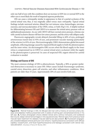 only one-­
half of eyes with this condition show an increase in IOP; low or normal IOP in the
other eyes is most likely the result of impaired aqueous production.
OIS can cause a retinopathy similar in appearance to that of a partial occlusion of the
central ret­
i­
nal vein; thus, it was originally called venous stasis retinopathy. Typical ret­i­nal
findings include narrowed arteries; dilated but not tortuous veins; hemorrhages; microan-
eurysms; and neovascularization of the ONH, ret­
ina, or both (Fig 6-14). A helpful method
for differentiating between OIS and CRVO is to mea­
sure the ret­
i­
nal artery pressure with an
ophthalmodynamometer. An eye with CRVO ­
will have normal artery pressure, whereas one
with carotid occlusive disease ­
will have low artery pressure, and the artery ­
will collapse easily.
Fluorescein angiography reveals delayed choroidal filling in 60% of eyes, prolonged
arteriovenous transit time in 95% of eyes, and prominent vascular staining (particularly
of the arteries) in 85% of eyes. Electroretinography (ERG) demonstrates global decreased
amplitude, reflecting damage caused by impaired blood supply to both the photoreceptors
and the inner ret­
ina. An electronegative ERG occurs when the blood supply to the inner
ret­
ina is compromised (as in CRVO or central ret­
i­
nal artery occlusion) while the supply
to the photoreceptors is preserved. In cases of suspected OIS, urgent referral for carotid
evaluation is needed.
Etiology and Course of OIS
The most common etiology of OIS is atherosclerosis. Typically, a 90% or greater ipsilat-
eral obstruction is necessary to cause OIS. Other ­
causes include Eisenmenger syndrome,
carotid artery dissection, ­
giant cell arteritis, and other inflammatory conditions. Most
patients are older than 55 years. Approximately 20% of cases involve both eyes.
A B
Figure 6-14 Retinal findings in OIS. An 80-­
year-­
old man with a history of coronary artery dis-
ease and diabetes mellitus presented with 2 weeks of aching pain and photosensitivity in his
left eye. A, Fundus photo­
graph shows dilated ret­
i­
nal veins without tortuosity and scattered
blot (round, deep) ret­
i­
nal hemorrhages in the equatorial area. Ret­
i­
nal scars from previous focal
macular ­
laser treatment for diabetic macular edema are also pre­
sent. B, Fluorescein angiogra-
phy revealed delayed arterial perfusion (not shown), hypofluorescence consistent with diffuse
capillary nonperfusion, and focal hyperfluorescence and leakage consistent with ret­
i­
nal neo-
vascularization. (Courtesy of Franco M. Recchia, MD.)
CHAPTER 6: Ret­
i­
nal Vascular Diseases Associated With Cardiovascular Disease ● 153
 