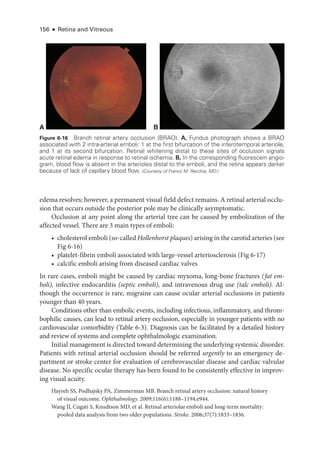 156 ● Retina and Vitreous
edema resolves; however, a permanent visual field defect remains. A ret­
i­
nal arterial occlu-
sion that occurs outside the posterior pole may be clinically asymptomatic.
Occlusion at any point along the arterial tree can be caused by embolization of the
affected vessel. ­
There are 3 main types of emboli:
• cholesterol emboli (so-­called Hollenhorst plaques) arising in the carotid arteries (see
Fig 6-16)
• platelet-­
fibrin emboli associated with large-­
vessel arteriosclerosis (Fig 6-17)
• calcific emboli arising from diseased cardiac valves
In rare cases, emboli might be caused by cardiac myxoma, long-­
bone fractures (fat em-
boli), infective endocarditis (septic emboli), and intravenous drug use (talc emboli). Al-
though the occurrence is rare, migraine can cause ocular arterial occlusions in patients
younger than 40 years.
Conditions other than embolic events, including infectious, inflammatory, and throm-
bophilic ­
causes, can lead to ret­
i­
nal artery occlusion, especially in younger patients with no
cardiovascular comorbidity (­
Table 6-3). Diagnosis can be facilitated by a detailed history
and review of systems and complete ophthalmologic examination.
Initial management is directed ­
toward determining the under­
lying systemic disorder.
Patients with ret­
i­
nal arterial occlusion should be referred urgently to an emergency de-
partment or stroke center for evaluation of cerebrovascular disease and cardiac valvular
disease. No specific ocular therapy has been found to be consistently effective in improv-
ing visual acuity.
Hayreh SS, Podhajsky PA, Zimmerman MB. Branch ret­
i­
nal artery occlusion: natu­
ral history
of visual outcome. Ophthalmology. 2009;116(6):1188–1194.e944.
Wang JJ, Cugati S, Knudtson MD, et al. Ret­
i­
nal arteriolar emboli and long-­
term mortality:
pooled data analy­
sis from two older populations. Stroke. 2006;37(7):1833–1836.
A B
Figure 6-16 Branch ret­
i­
nal artery occlusion (BRAO). A, Fundus photo­
graph shows a BRAO
associated with 2 intra-­
arterial emboli: 1 at the first bifurcation of the inferotemporal arteriole,
and 1 at its second bifurcation. Ret­
i­
nal whitening distal to ­
these sites of occlusion signals
acute ret­
i­
nal edema in response to ret­
i­
nal ischemia. B, In the corresponding fluorescein angio-
gram, blood flow is absent in the arterioles distal to the emboli, and the ret­
ina appears darker
­
because of lack of capillary blood flow. (Courtesy of Franco M. Recchia, MD.)
 