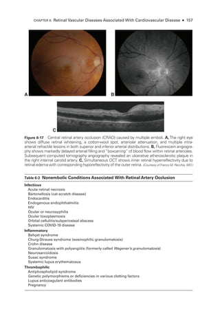 C
A B
Figure 6-17 Central ret­
i­
nal artery occlusion (CRAO) caused by multiple emboli. A, The right eye
shows diffuse ret­
i­
nal whitening, a cotton-­
wool spot, arteriolar attenuation, and multiple intra-­
arterial refractile lesions in both superior and inferior arterial distributions. B, Fluorescein angiogra-
phy shows markedly delayed arterial filling and “boxcarring” of blood flow within ret­
i­
nal arterioles.
Subsequent computed tomography angiography revealed an ulcerative atherosclerotic plaque in
the right internal carotid artery. C, Simultaneous OCT shows inner ret­
i­
nal hyperreflectivity due to
ret­
i­
nal edema with corresponding hyporeflectivity of the outer ret­
ina. (Courtesy of Franco M. Recchia, MD.)
­Table 6-3 ​Nonembolic Conditions Associated With Ret­i­nal Artery Occlusion
Infectious
Acute ret­i­nal necrosis
Bartonellosis (cat-­
scratch disease)
Endocarditis
Endogenous endophthalmitis
HIV
Ocular or neurosyphilis
Ocular toxoplasmosis
Orbital cellulitis/subperiosteal abscess
Systemic COVID-19 disease
Inflammatory
Behçet syndrome
Churg-­
Strauss syndrome (eosinophilic granulomatosis)
Crohn disease
Granulomatosis with polyangiitis (formerly called Wegener’s granulomatosis)
Neurosarcoidosis
Susac syndrome
Systemic lupus erythematosus
Thrombophilic
Antiphospholipid syndrome
Ge­
ne­
tic polymorphisms or deficiencies in vari­
ous clotting ­
factors
Lupus anticoagulant antibodies
Pregnancy
CHAPTER 6: Ret­
i­
nal Vascular Diseases Associated With Cardiovascular Disease ● 157
 