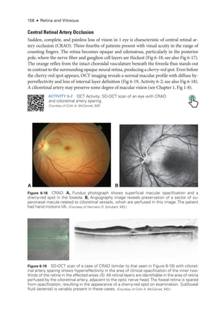 158 ● Retina and Vitreous
Central Ret­
i­
nal Artery Occlusion
Sudden, complete, and painless loss of vision in 1 eye is characteristic of central ret­
i­
nal ar-
tery occlusion (CRAO). Three-­
fourths of patients pre­
sent with visual acuity in the range of
counting fin­
gers. The ret­
ina becomes opaque and edematous, particularly in the posterior
pole, where the nerve fiber and ganglion cell layers are thickest (Fig 6-18; see also Fig 6-17).
The orange reflex from the intact choroidal vasculature beneath the foveola thus stands out
in contrast to the surrounding opaque neural ret­
ina, producing a cherry-­red spot. Even before
the cherry-­
red spot appears, OCT imaging reveals a normal macular profile with diffuse hy-
perreflectivity and loss of internal layer definition (Fig 6-19, Activity 6-2; see also Fig 6-18).
A cilioret­
i­
nal artery may preserve some degree of macular vision (see Chapter 1, Fig 1-­
8).
ACTIVITY 6-2 OCT Activity: SD-­
OCT scan of an eye with CRAO
and cilioret­
i­
nal artery sparing.
Courtesy of Colin A. McCannel, MD.
X X
*
Figure 6-19 SD-­
OCT scan of a case of CRAO (similar to that seen in Figure 6-18) with cilioret­
i­
nal artery sparing shows hyperreflectivity in the area of clinical opacification of the inner two-­
thirds of the ret­
ina in the affected areas (X). All ret­
i­
nal layers are identifiable in the area of ret­
ina
perfused by the cilioret­
i­
nal artery, adjacent to the optic nerve head. The foveal ret­
ina is spared
from opacification, resulting in the appearance of a cherry-­
red spot on examination. Subfoveal
fluid (asterisk) is variably pre­
sent in ­
these cases. (Courtesy of Colin A. McCannel, MD.)
A B
Figure 6-18 CRAO. A, Fundus photo­
graph shows superficial macular opacification and a
cherry-­
red spot in the foveola. B, Angiography image reveals preservation of a sector of su-
peronasal macula related to cilioret­
i­
nal vessels, which are perfused in this image. The patient
had hand motions VA. (Courtesy of Hermann D. Schubert, MD.)
 