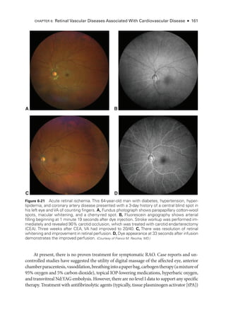 At pre­
sent, ­
there is no proven treatment for symptomatic RAO. Case reports and un-
controlled studies have suggested the utility of digital massage of the affected eye, anterior
chamberparacentesis,vasodilation,breathingintoapaperbag,carbogentherapy(amixtureof
95% oxygen and 5% carbon dioxide), topical IOP-­
lowering medi­
cations, hyperbaric oxygen,
and transvitreal Nd:YAG embolysis. However, ­
there are no level I data to support any specific
therapy. Treatment with antifibrinolytic agents (typically, tissue plasminogen activator [tPA])
A
C D
B
Figure 6-21 Acute ret­
i­
nal ischemia. This 64-­
year-­
old man with diabetes, hypertension, hyper-
lipidemia, and coronary artery disease presented with a 3-­
day history of a central blind spot in
his left eye and VA of counting fin­
gers. A, Fundus photo­
graph shows parapapillary cotton-­
wool
spots, macular whitening, and a cherry-­
red spot. B, Fluorescein angiography shows arterial
filling beginning at 1 minute 19 seconds ­
after dye injection. Stroke workup was performed im-
mediately and revealed 90% carotid occlusion, which was treated with carotid endarterectomy
(CEA). Three weeks ­
after CEA, VA had improved to 20/40. C, ­
There was resolution of ret­
i­
nal
whitening and improvement in ret­
i­
nal perfusion. D, Dye appearance at 33 seconds ­
after infusion
demonstrates the improved perfusion. (Courtesy of Franco M. Recchia, MD.)
CHAPTER 6: Ret­
i­
nal Vascular Diseases Associated With Cardiovascular Disease ● 161
 