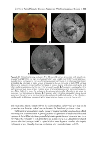and outer ret­
ina become opacified from the infarction; thus, a cherry-­
red spot may not be
pre­
sent ­
because ­
there is a lack of contrast between the foveal and perifoveal ret­
ina.
Ophthalmic artery occlusion may be caused by internal carotid artery dissection, orbital
mucormycosis, or embolization. A growing number of ophthalmic artery occlusions caused
by cosmetic facial-­
filler injections, particularly into the periocular and brow area, have been
reported as the popularity of such procedures has increased (Fig 6-23). In autopsy studies of
patients who died during active GCA, up to 76% had some degree of vasculitis affecting the
ophthalmic artery; clinically, however, ophthalmic artery occlusion is rare in GCA.
C
A B
Figure 6-22 Cilioretinal artery occlusion. This 53-­
year-­
old ­
woman presented with acutely de-
creased VA of 20/400 in her right eye. Medical history was notable for 2 first-­
trimester spontane-
ous abortions, and systemic workup ultimately revealed high levels of circulating anticardiolipin
antibodies. A, Montage of color fundus photo­
graphs shows ele­
ments of both RVO (venous
dilation and tortuosity, intraret­
i­
nal hemorrhages at vari­
ous layers, and cotton-­
wool spots) and
cilioret­
i­
nal artery occlusion (whitening in the temporal macula). B, Fluorescein angiography in the
early arteriovenous phase shows multiple areas of arterial occlusion and peripheral nonperfu-
sion. Note that in this case, the occlusions do not occur at arteriolar bifurcations, as would be
expected in embolic occlusive disease. C, Angiogram taken in the late recirculation phase shows
staining of the ret­
i­
nal veins, per­
sis­
tent arteriolar occlusion (notably, in branches of the inferotem-
poral arcade), and leakage consistent with macular edema. (Courtesy of Franco M. Recchia, MD.)
CHAPTER 6: Ret­
i­
nal Vascular Diseases Associated With Cardiovascular Disease ● 163
 