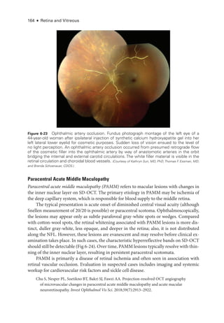 164 ● Retina and Vitreous
Paracentral Acute ­
Middle Maculopathy
Paracentral acute ­
middle maculopathy (PAMM) refers to macular lesions with changes in
the inner nuclear layer on SD-­
OCT. The primary etiology in PAMM may be ischemia of
the deep capillary system, which is responsible for blood supply to the ­
middle ret­
ina.
The typical pre­
sen­
ta­
tion is acute onset of diminished central visual acuity (although
Snellen mea­
sure­
ment of 20/20 is pos­
si­
ble) or paracentral scotoma. Ophthalmoscopically,
the lesions may appear only as subtle parafoveal gray-­
white spots or wedges. Compared
with cotton-­
wool spots, the ret­
i­
nal whitening associated with PAMM lesions is more dis-
tinct, duller gray-­
white, less opaque, and deeper in the ret­
i­
na; also, it is not distributed
along the NFL. However, ­
these lesions are evanescent and may resolve before clinical ex-
amination takes place. In such cases, the characteristic hyperreflective bands on SD-­
OCT
should still be detectable (Fig 6-24). Over time, PAMM lesions typically resolve with thin-
ning of the inner nuclear layer, resulting in per­
sis­
tent paracentral scotomata.
PAMM is primarily a disease of ret­
i­
nal ischemia and often seen in association with
ret­
i­
nal vascular occlusion. Evaluation in suspected cases includes imaging and systemic
workup for cardiovascular risk ­
factors and sickle cell disease.
Chu S, Nesper PL, Soetikno BT, Bakri SJ, Fawzi AA. Projection-­
resolved OCT angiography
of microvascular changes in paracentral acute ­
middle maculopathy and acute macular
neuroretinopathy. Invest Ophthalmol Vis Sci. 2018;59(7):2913–2922.
Figure 6-23 Ophthalmic artery occlusion. Fundus photo­
graph montage of the left eye of a
44-­
year-­
old ­
woman ­
after ipsilateral injection of synthetic calcium hydroxyapatite gel into her
left lateral lower eyelid for cosmetic purposes. Sudden loss of vision ensued to the level of
no light perception. An ophthalmic artery occlusion occurred from presumed retrograde flow
of the cosmetic filler into the ophthalmic artery by way of anastomotic arteries in the orbit
bridging the internal and external carotid circulations. The white filler material is vis­
i­
ble in the
ret­
i­
nal circulation and choroidal blood vessels. (Courtesy of Kathryn Sun, MD, PhD;Thomas F
. Essman, MD;
and Brenda Schoenauer, CDOS.)
 