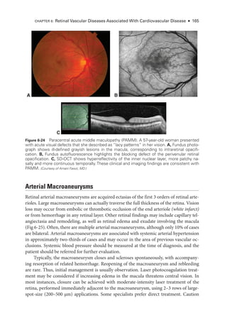 Arterial Macroaneurysms
Ret­
i­
nal arterial macroaneurysms are acquired ectasias of the first 3 ­
orders of ret­
i­
nal arte-
rioles. Large macroaneurysms can actually traverse the full thickness of the ret­
ina. Vision
loss may occur from embolic or thrombotic occlusion of the end arteriole (white infarct)
or from hemorrhage in any ret­
i­
nal layer. Other ret­
i­
nal findings may include capillary tel-
angiectasia and remodeling, as well as ret­
i­
nal edema and exudate involving the macula
(Fig 6-25). Often, ­
there are multiple arterial macroaneurysms, although only 10% of cases
are bilateral. Arterial macroaneurysms are associated with systemic arterial hypertension
in approximately two-­
thirds of cases and may occur in the area of previous vascular oc-
clusions. Systemic blood pressure should be mea­
sured at the time of diagnosis, and the
patient should be referred for further evaluation.
Typically, the macroaneurysm closes and scleroses spontaneously, with accompany-
ing resorption of related hemorrhage. Reopening of the macroaneurysm and rebleeding
are rare. Thus, initial management is usually observation. ­
Laser photocoagulation treat-
ment may be considered if increasing edema in the macula threatens central vision. In
most instances, closure can be achieved with moderate-­
intensity ­
laser treatment of the
ret­
ina, performed immediately adjacent to the macroaneurysm, using 2–3 rows of large-­
spot-­
size (200–500 µm) applications. Some specialists prefer direct treatment. Caution
A B
C
Figure 6-24 Paracentral acute ­
middle maculopathy (PAMM). A 57-­
year-­
old ­
woman presented
with acute visual defects that she described as “lacy patterns” in her vision. A, Fundus photo­
graph shows ill-­
defined grayish lesions in the macula, corresponding to intraret­
i­
nal opacifi-
cation. B, Fundus autofluorescence highlights the blocking defect of the perivenular ret­
i­
nal
opacification. C, SD-­
OCT shows hyperreflectivity of the inner nuclear layer, more patchy na-
sally and more continuous temporally. ­
These clinical and imaging findings are consistent with
PAMM. (Courtesy of Amani Fawzi, MD.)
CHAPTER 6: Ret­
i­
nal Vascular Diseases Associated With Cardiovascular Disease ● 165
 