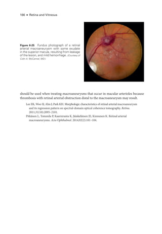 166 ● Retina and Vitreous
should be used when treating macroaneurysms that occur in macular arterioles ­
because
thrombosis with ret­
i­
nal arterial obstruction distal to the macroaneurysm may result.
Lee EK, Woo SJ, Ahn J, Park KH. Morphologic characteristics of ret­
i­
nal arterial macroaneurysm
and its regression pattern on spectral-­
domain optical coherence tomography. Ret­i­na.
2011;31(10):2095–2101.
Pitkänen L, Tommila P, Kaarniranta K, Jääskeläinen JE, Kinnunen K. Ret­
i­
nal arterial
macroaneurysms. Acta Ophthalmol. 2014;92(2):101–104.
Figure 6-25 Fundus photo­
graph of a ret­
i­
nal
arterial macroaneurysm with some exudate
in the superior macula, resulting from leakage
of the lesion, and mild hemorrhage. (Courtesy of
Colin A. McCannel, MD.)
 