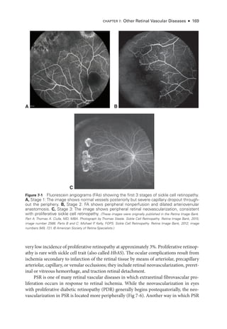 CHAPTER 7: Other Ret­i­nal Vascular Diseases ● 169
A
C
B
Figure 7-1 Fluorescein angiograms (FAs) showing the first 3 stages of sickle cell retinopathy.
A, Stage 1: The image shows normal vessels posteriorly but severe capillary dropout through-
out the periphery. B, Stage 2: FA shows peripheral nonperfusion and dilated arteriovenular
anastomosis. C, Stage 3: The image shows peripheral ret­
i­
nal neovascularization, consistent
with proliferative sickle cell retinopathy. (­
These images ­
were originally published in the Ret­
ina Image Bank.
Part A: Thomas A. Ciulla, MD, MBA. Photo­
graph by Thomas Steele. Sickle Cell Retinopathy. Ret­
ina Image Bank, 2015;
image number 2566. Parts B and C: Michael P
. Kelly, FOPS. Sickle Cell Retinopathy. Ret­
ina Image Bank, 2012; image
numbers 949, 721. © American Society of Ret­
ina Specialists.)
very low incidence of proliferative retinopathy at approximately 3%. Proliferative retinop-
athy is rare with sickle cell trait (also called HbAS). The ocular complications result from
ischemia secondary to infarction of the ret­
i­
nal tissue by means of arteriolar, precapillary
arteriolar, capillary, or venular occlusions; they include ret­
i­
nal neovascularization, preret­
i­
nal or vitreous hemorrhage, and traction ret­
i­
nal detachment.
PSR is one of many ret­
i­
nal vascular diseases in which extraret­
i­
nal fibrovascular pro-
liferation occurs in response to ret­
i­
nal ischemia. While the neovascularization in eyes
with proliferative diabetic retinopathy (PDR) generally begins postequatorially, the neo-
vascularization in PSR is located more peripherally (Fig 7-6). Another way in which PSR
 