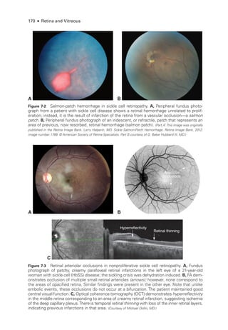 170 ● Retina and Vitreous
A B
Figure 7-2 Salmon-­
patch hemorrhage in sickle cell retinopathy. A, Peripheral fundus photo­
graph from a patient with sickle cell disease shows a ret­
i­
nal hemorrhage unrelated to prolif-
eration; instead, it is the result of infarction of the ret­
ina from a vascular occlusion—­
a salmon
patch. B, Peripheral fundus photo­
graph of an iridescent, or refractile, patch that represents an
area of previous, now resorbed, ret­
i­
nal hemorrhage (salmon patch). (Part A: This image was originally
published in the Ret­
ina Image Bank. Larry Halperin, MD. Sickle Salmon-­
Patch Hemorrhage. Ret­
ina Image Bank, 2012;
image number 1789. © American Society of Ret­
ina Specialists. Part B courtesy of G. Baker Hubbard III, MD.)
A B
Arteriolar
occlusions
C
Hyperreflectivity
Retinal thinning
Figure 7-3 Retinal arteriolar occlusions in nonproliferative sickle cell retinopathy. A, Fundus
photo­
graph of patchy, creamy parafoveal ret­
i­
nal infarctions in the left eye of a 21-­
year-­
old
­
woman with sickle cell (HbSS) disease; the sickling crisis was dehydration induced. B, FA dem-
onstrates occlusion of multiple small ret­
i­
nal arterioles (arrows); however, none correspond to
the areas of opacified ret­
ina. Similar findings ­
were pre­
sent in the other eye. Note that unlike
embolic events, ­
these occlusions do not occur at a bifurcation. The patient maintained good
central visual function. C, Optical coherence tomography (OCT) demonstrates hyperreflectivity
in the ­
middle ret­
ina corresponding to an area of creamy ret­
i­
nal infarction, suggesting ischemia
of the deep capillary plexus.­
There is temporal ret­i­nal thinning with loss of the inner ret­
i­
nal layers,
indicating previous infarctions in that area. (Courtesy of Michael Dollin, MD.)
 