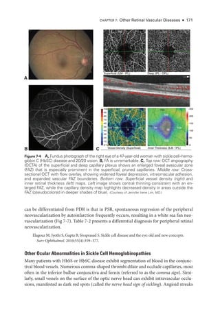 can be differentiated from PDR is that in PSR, spontaneous regression of the peripheral
neovascularization by autoinfarction frequently occurs, resulting in a white sea fan neo-
vascularization (Fig 7-7). ­Table 7-2 pre­
sents a differential diagnosis for peripheral ret­
i­
nal
neovascularization.
Elagouz M, Jyothi S, Gupta B, Sivaprasad S. Sickle cell disease and the eye: old and new concepts.
Surv Ophthalmol. 2010;55(4):359–377.
Other Ocular Abnormalities in Sickle Cell Hemoglobinopathies
Many patients with HbSS or HbSC disease exhibit segmentation of blood in the conjunc-
tival blood vessels. Numerous comma-­
shaped thrombi dilate and occlude capillaries, most
often in the inferior bulbar conjunctiva and fornix (referred to as the comma sign). Simi-
larly, small vessels on the surface of the optic nerve head can exhibit intravascular occlu-
sions, manifested as dark red spots (called the nerve head sign of sickling). Angioid streaks
A
B C
150 150
156
150 150
105
109
102
94
38
156
156
46
5
44
44
45
156
Superficial (ILM - IPL)
Vessel Density (Superficial) Inner Thickness (ILM - IPL)
100 250
200
150
100
50
0
90
80
70
60
50
40
30
20
10
0 %
Deep (IPL - OPL)
Figure 7-4 A, Fundus photo­
graph of the right eye of a 47-­
year-­
old ­
woman with sickle cell–hemo-
globin C (HbSC) disease and 20/20 vision. B, FA is unremarkable. C, Top row: OCT angiography
(OCTA) of the superficial and deep capillary plexus shows an enlarged foveal avascular zone
(FAZ) that is especially prominent in the superficial, pruned capillaries. ­Middle row: Cross-­
sectional OCT with flow overlay, showing widened foveal depression, vitreomacular adhesion,
and expanded vascular FAZ bound­
aries. Bottom row: Superficial vessel density (right) and
inner ret­i­nal thickness (left) maps. Left image shows central thinning consistent with an en-
larged FAZ, while the capillary density map highlights decreased density in areas outside the
FAZ (pseudocolored in deeper shades of blue). (Courtesy of Jennifer Irene Lim, MD.)
CHAPTER 7: Other Ret­i­nal Vascular Diseases ● 171
 