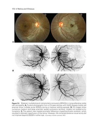 172 ● Retina and Vitreous
A
B
C
Figure 7-5 Bilateral, multiple branch ret­
i­
nal artery occlusions (BRAOs) in nonproliferative sickle
cell retinopathy. A, Fundus photo­
graphs from a 5½-­
year-­
old boy with HbSS disease (sickle cell
anemia) show multiple acute BRAOs during a massive sickling episode. B, FA images show
numerous medium and large arteriolar vessel occlusions (arrows), notably not located at bi-
furcations. C, The patient was treated promptly following a hypertransfusion protocol, which
resulted in dramatic reperfusion of the ret­
ina. However, the corrected distance visual acuity did
not improve beyond 20/200 in ­
either eye. (Courtesy of Brian Leonard, MD.)
 