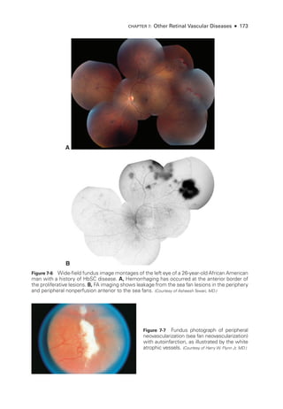 A
B
Figure 7-6 Wide-­
field fundus image montages of the left eye of a 26-­
year-­
old African American
man with a history of HbSC disease. A, Hemorrhaging has occurred at the anterior border of
the proliferative lesions. B, FA imaging shows leakage from the sea fan lesions in the periphery
and peripheral nonperfusion anterior to the sea fans. (Courtesy of Asheesh Tewari, MD.)
Figure 7-7 Fundus photo­
graph of peripheral
neovascularization (sea fan neovascularization)
with autoinfarction, as illustrated by the white
atrophic vessels. (Courtesy of Harry W. Flynn Jr, MD.)
CHAPTER 7: Other Ret­i­nal Vascular Diseases ● 173
 
