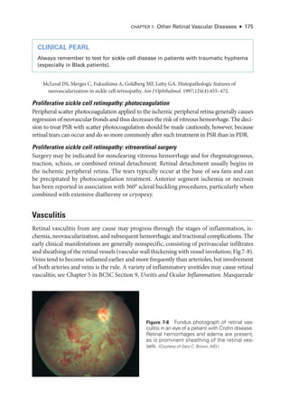 CLINICAL PEARL
Always remember to test for sickle cell disease in patients with traumatic hyphema
(especially in Black patients).
McLeod DS, Merges C, Fukushima A, Goldberg MF, Lutty GA. Histopathologic features of
neovascularization in sickle cell retinopathy. Am J Ophthalmol. 1997;124(4):455–472.
Proliferative sickle cell retinopathy: photocoagulation
Peripheral scatter photocoagulation applied to the ischemic peripheral ret­
ina generally ­
causes
regression of neovascular fronds and thus decreases the risk of vitreous hemorrhage. The deci-
sion to treat PSR with scatter photocoagulation should be made cautiously, however, ­
because
ret­
i­
nal tears can occur and do so more commonly ­
after such treatment in PSR than in PDR.
Proliferative sickle cell retinopathy: vitreoret­
i­
nal surgery
Surgery may be indicated for nonclearing vitreous hemorrhage and for rhegmatogenous,
traction, schisis, or combined ret­
i­
nal detachment. Ret­
i­
nal detachment usually begins in
the ischemic peripheral ret­
ina. The tears typically occur at the base of sea fans and can
be precipitated by photocoagulation treatment. Anterior segment ischemia or necrosis
has been reported in association with 360° scleral buckling procedures, particularly when
combined with extensive diathermy or cryopexy.
Vasculitis
Ret­
i­
nal vasculitis from any cause may pro­
gress through the stages of inflammation, is­
chemia, neovascularization, and subsequent hemorrhagic and tractional complications. The
early clinical manifestations are generally nonspecific, consisting of perivascular infiltrates
and sheathing of the ret­i­nal vessels (vascular wall thickening with vessel involution; Fig 7-8).
Veins tend to become inflamed ­
earlier and more frequently than arterioles, but involvement
of both arteries and veins is the rule. A variety of inflammatory uveitides may cause ret­
i­
nal
vasculitis; see ­
Chapter 5 in BCSC Section 9, Uveitis and Ocular Inflammation. Masquerade
Figure 7-8 Fundus photo­
graph of ret­
i­
nal vas-
culitis in an eye of a patient with Crohn disease.
Ret­
i­
nal hemorrhages and edema are pre­
sent,
as is prominent sheathing of the ret­
i­
nal ves-
sels. (Courtesy of Gary C. Brown, MD.)
CHAPTER 7: Other Ret­i­nal Vascular Diseases ● 175
 